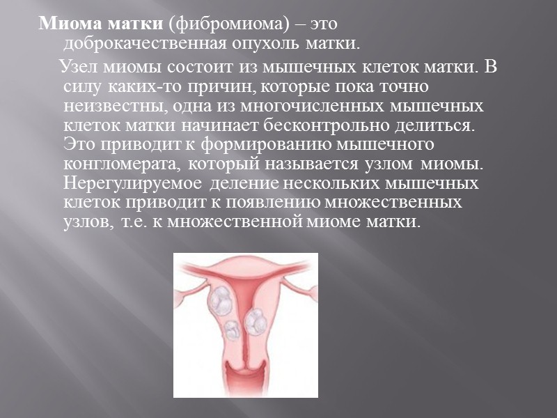 Миома матки (фибромиома) – это доброкачественная опухоль матки.     Узел миомы