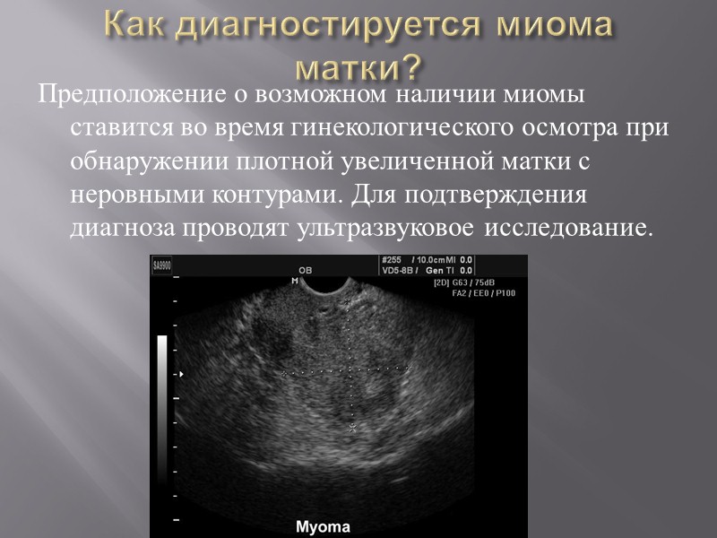 Полость матки деформирована. Шеечный миоматозный узел. УЗИ признаки миомы тела матки.