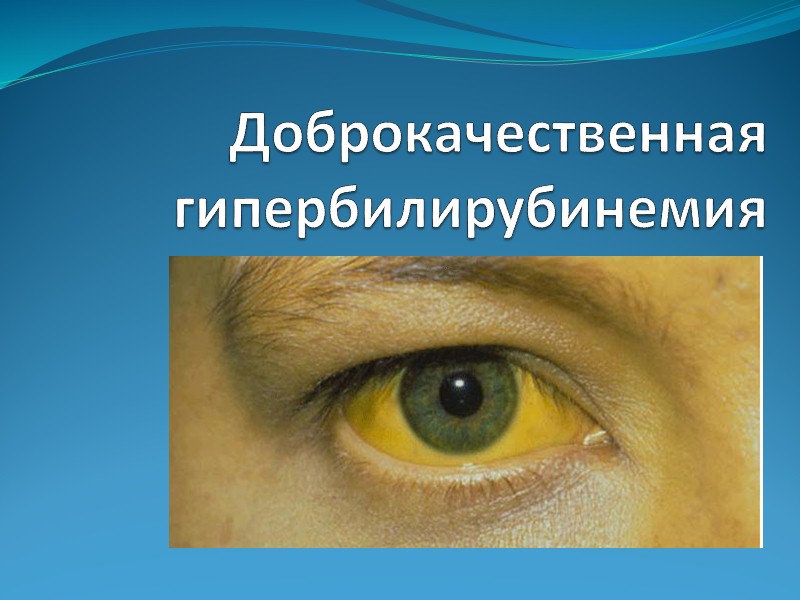 Доброкачественная   гипербилирубинемия