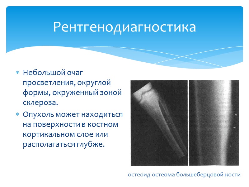 Остеоид остеома бедренной кости. Компактная остеома большеберцовой кости. Остеома кости рентген признаки.