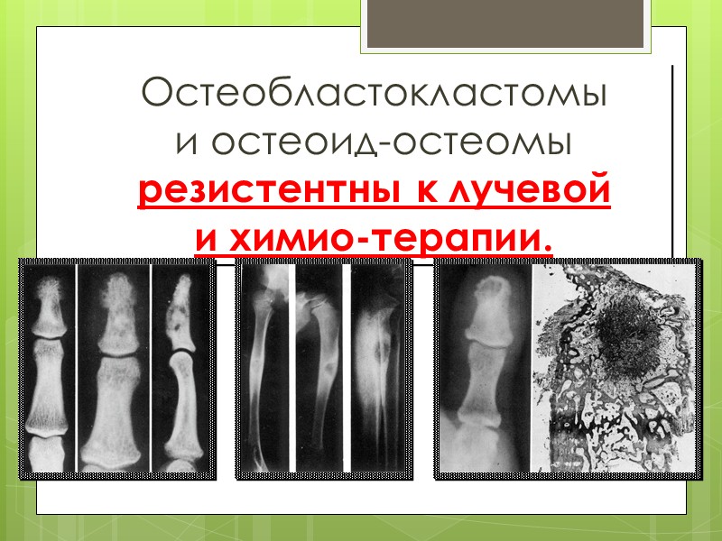 ОСТЕОИД-ОСТЕОМА Макроскопия:  в толще склерозированной кости выявляется «гнездо» - очаг красноватой, похожей на