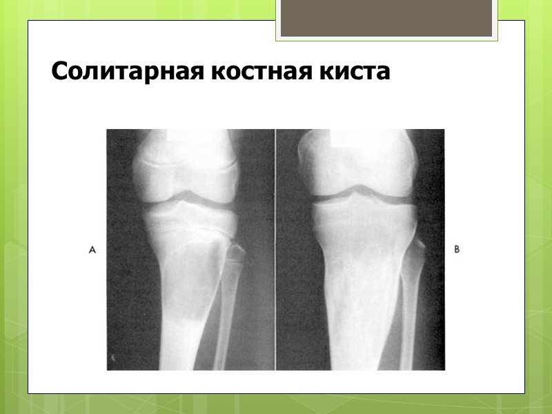 Остеохондрома (костно-хрящевой экзостоз)  Поражается метафиз  длинной трубчатой кости или плоская кость Неподвижная