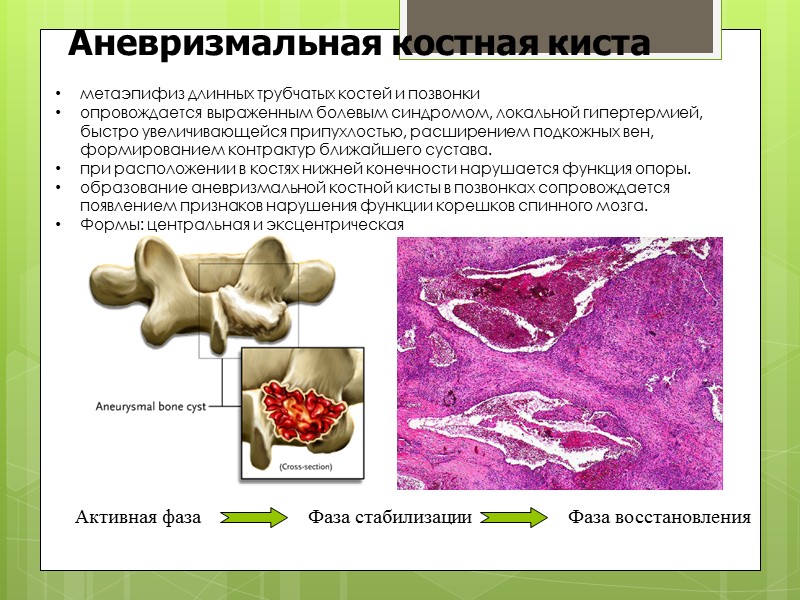 Остеохондрома (костно-хрящевой экзостоз)  Лучевая кость Бедренная кость