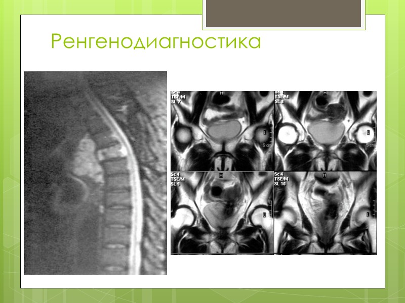 Солитарная костная киста