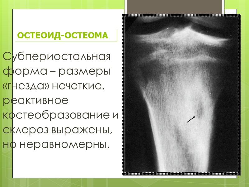 Остеома бедренной кости. Остеома диафиза большеберцовой кости. Остеома бедренной кости рентген. Характерный признак остеоид- остеомы:. Остеома большеберцовой кости описание.