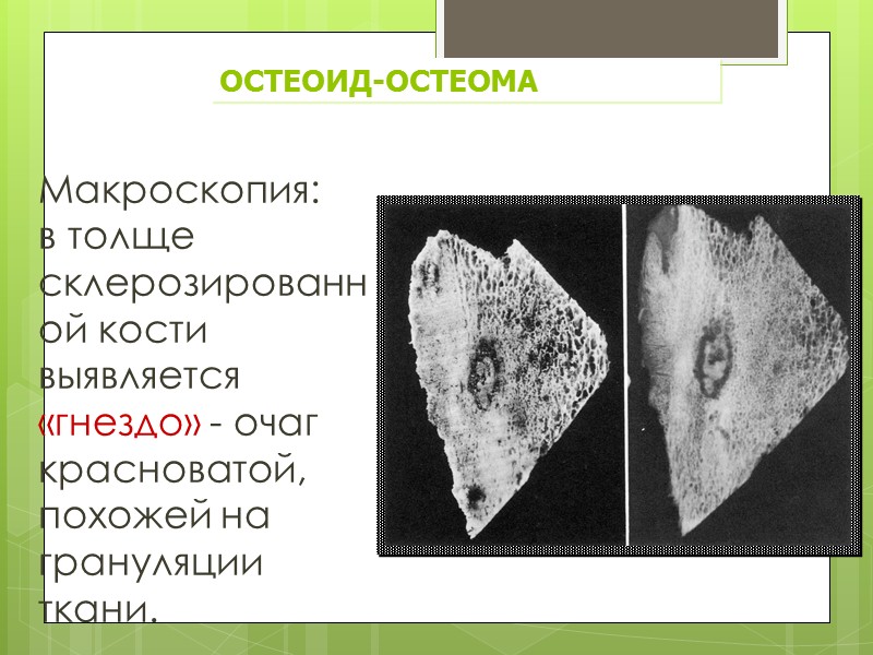 Рентгенодиагностика губчатая остеома  лучевой кости компактная остеома,  исходящая из стен лобной пазухи