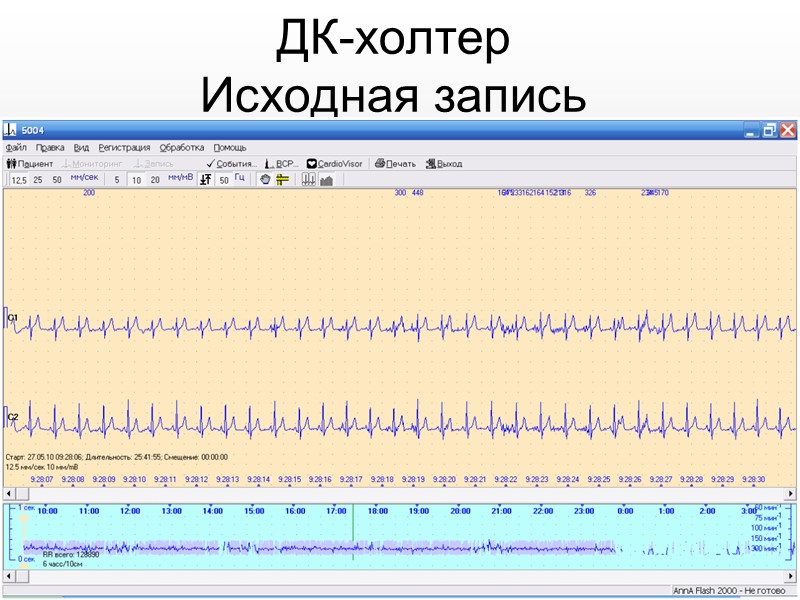 В настоящее время большое значение  при тестировании придают ST/HR- индексу. Этот подход позволяет