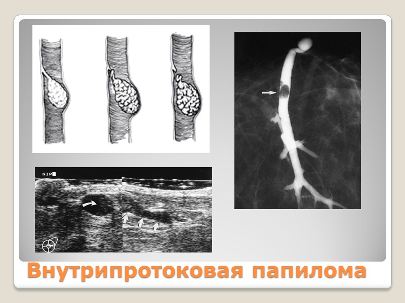 Деформации молочных желез, связанные с травмами (хирургическими вмешательствами)