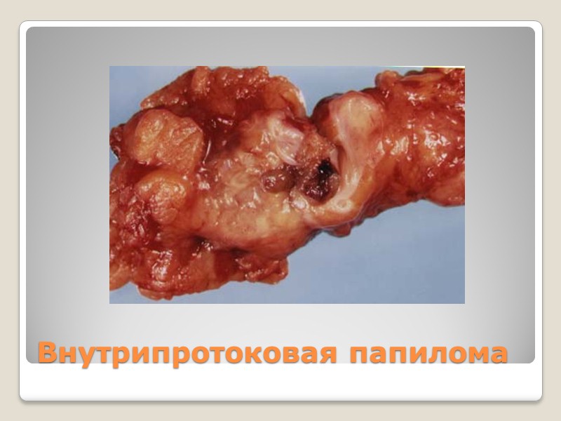 Фиброзно-кистозная мастопатия Кисты Аденоз Метаплазия Эпителиальная гиперплазия Протоковая гиперплазия Дольковая гиперплазия Радиальный рубец Внутрипротоковая