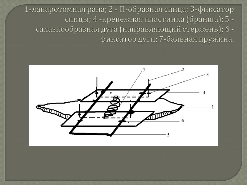 Вступление  Основным критерием выбора метода хирургического лечения распространенного гнойного перитонита (РГП) считается его