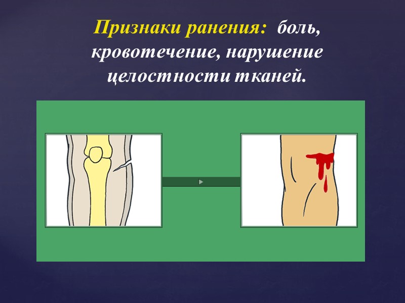 Остановка кровотечения из подключной артерии путём максимального отвода рук назад Максимально отвести назад левое