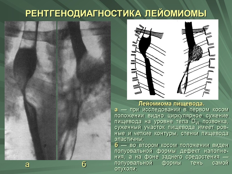 РЕНТГЕНОЛОГИЧЕСКИЕ СИМПТОМЫ ЛЕЙОМИОМЫ  Обусловлены особенностью распо-ложения и роста этого вида опухоли, которая ведет