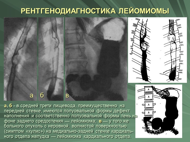 Встречается и подковообразная лейомиома, когда поражаются две противоположные стенки. Тогда наблюдается картина муфты или