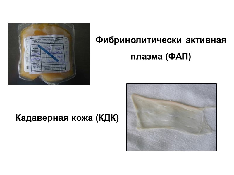 Локализация повреждений Нижняя конечность - 56 чел. Верх. конечность - 44 чел. у госпитализированных