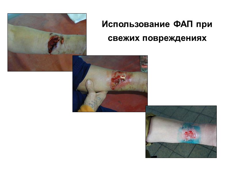 Множественная локализация повреждений – 23 чел.