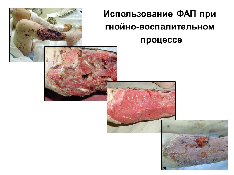 2-е СУТКИ 5-е СУТКИ Поверхностный некроз  1-е СУТКИ
