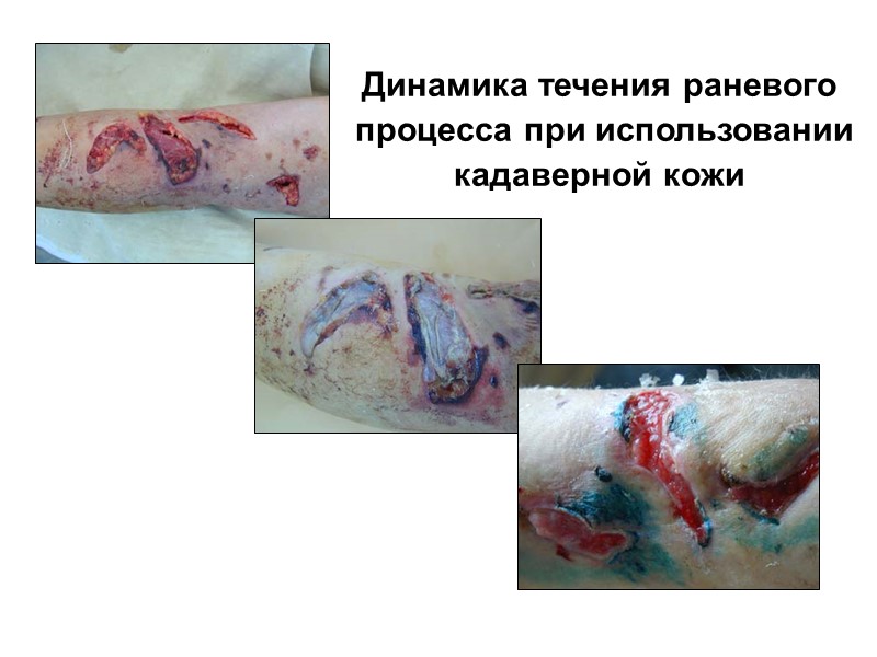 Фибринолитически активная  плазма (ФАП) Кадаверная кожа (КДК)