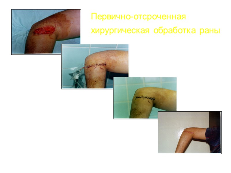Использование ФАП при свежих повреждениях 2-е СУТКИ 7-е СУТКИ 17-е СУТКИ
