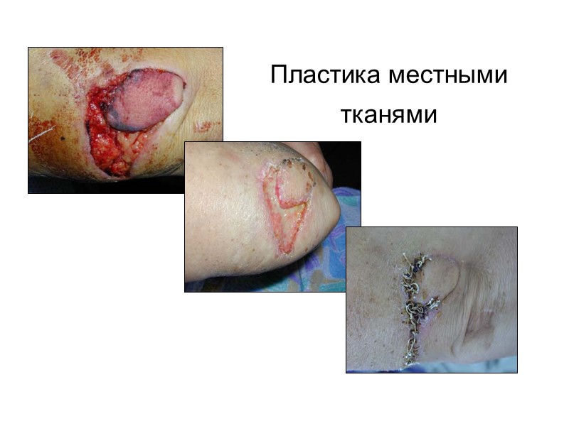 8-е СУТКИ Использование ФАП при гнойно-воспалительном  процессе 33-и СУТКИ 12-е СУТКИ 23-и СУТКИ