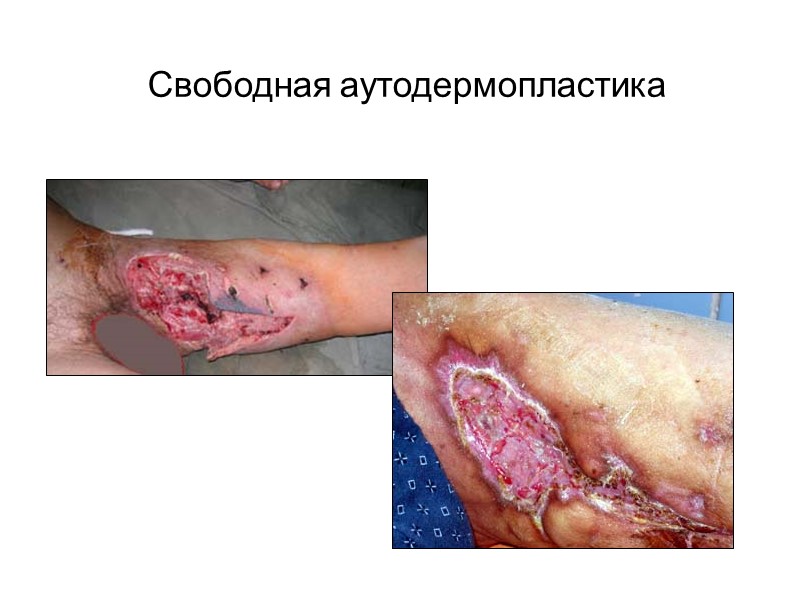Способ применения КДК: Кожные лоскуты помещаются в NaCl 0.9%: сухие на 1-1.5 часа, а