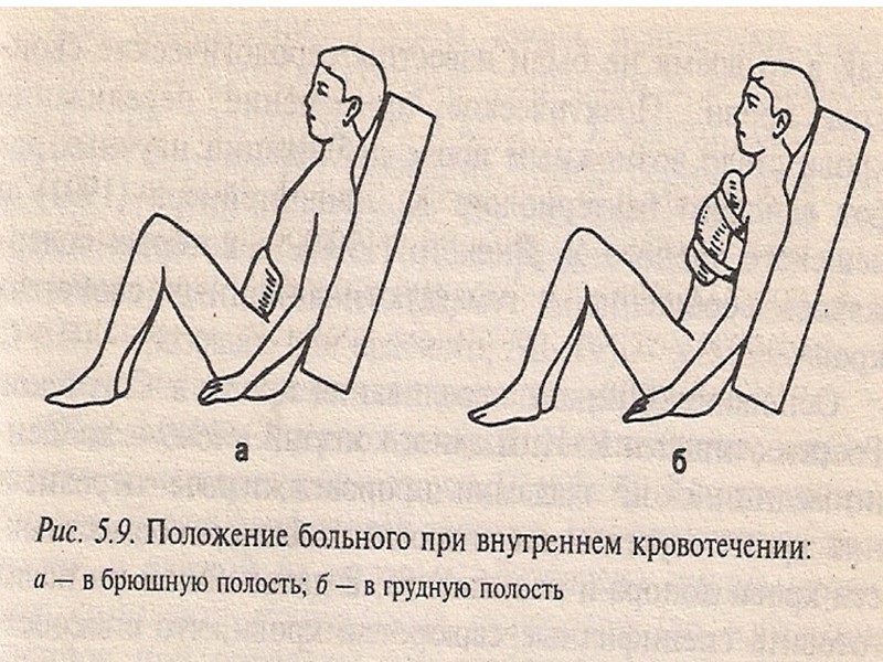 Положение при кровотечении