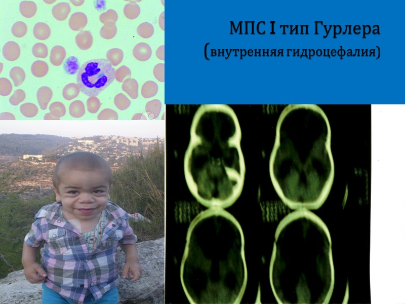 Наследование митохондриальных болезней Митохондрии наследуются иначе, чем ядерные гены. Ядерные гены в каждой соматической