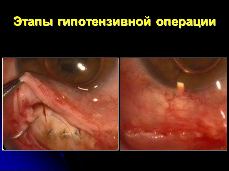 Микрохирургия глаукомы (дренажи)