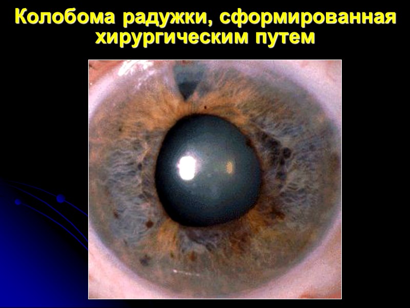 Дренажная система глаза