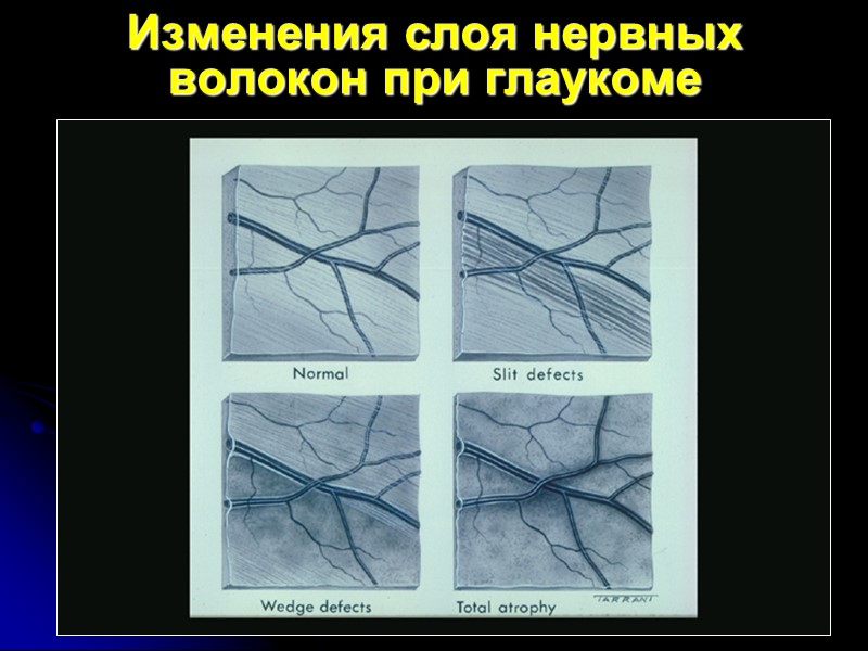 Изменения слоя нервных волокон при глаукоме