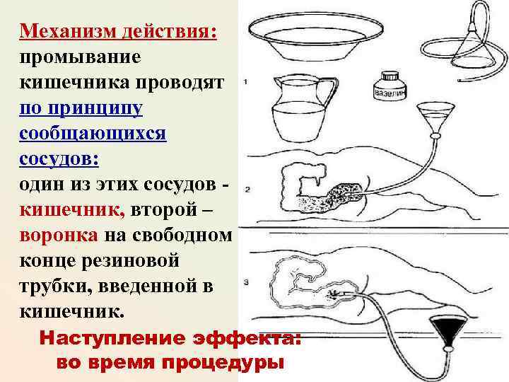 Механизм действия: промывание кишечника проводят по принципу сообщающихся сосудов: один из этих сосудов -