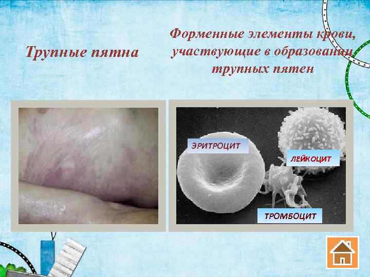 Трупные пятна Форменные элементы крови, участвующие в образовании трупных пятен ЭРИТРОЦИТ ЛЕЙКОЦИТ ТРОМБОЦИТ 