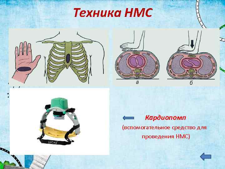 Техника НМС • Кардиопомп • (вспомогательное средство для • проведения НМС) 