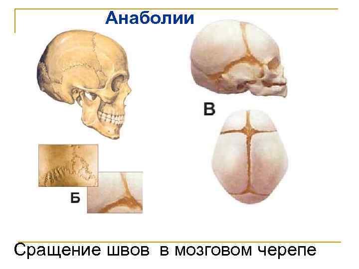 Анаболии Сращение швов в мозговом черепе 