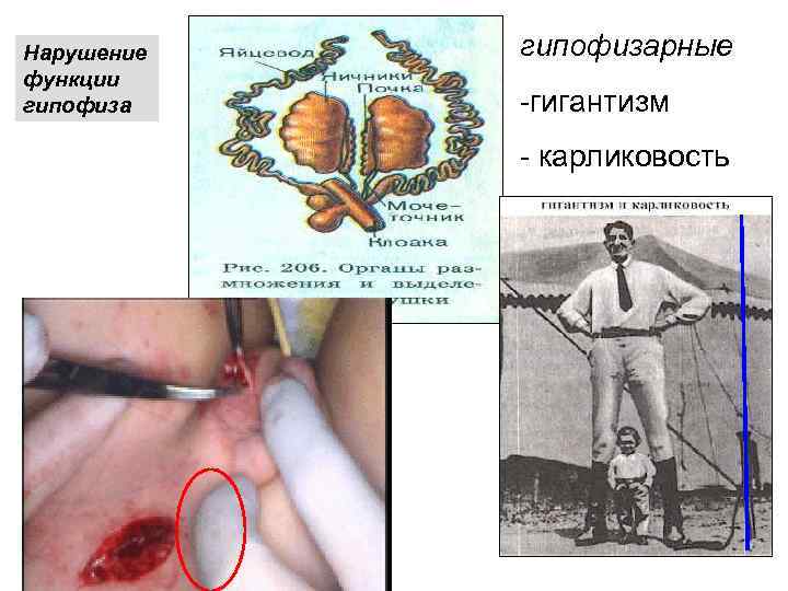 Нарушение функции гипофизарные -гигантизм - карликовость 