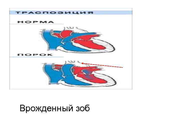 Врожденный зоб 