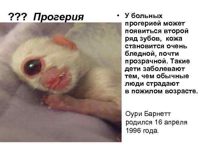 ? ? ? Прогерия • У больных прогерией может появиться второй ряд зубов, кожа