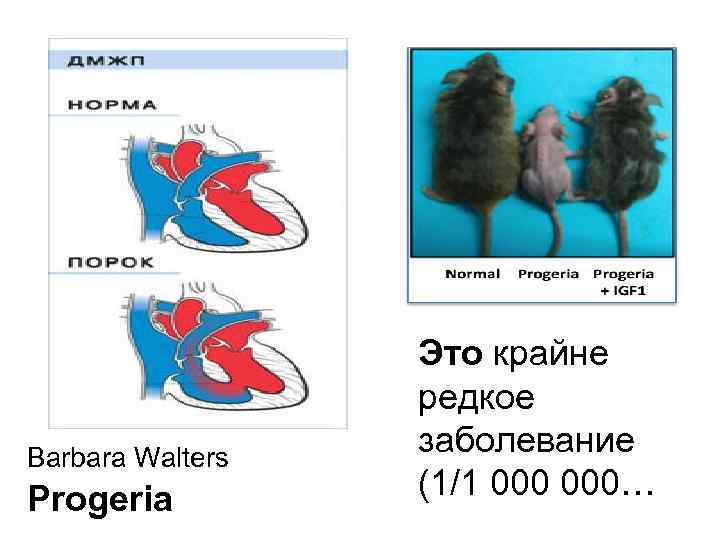 Barbara Walters Progeria Это крайне редкое заболевание (1/1 000… 