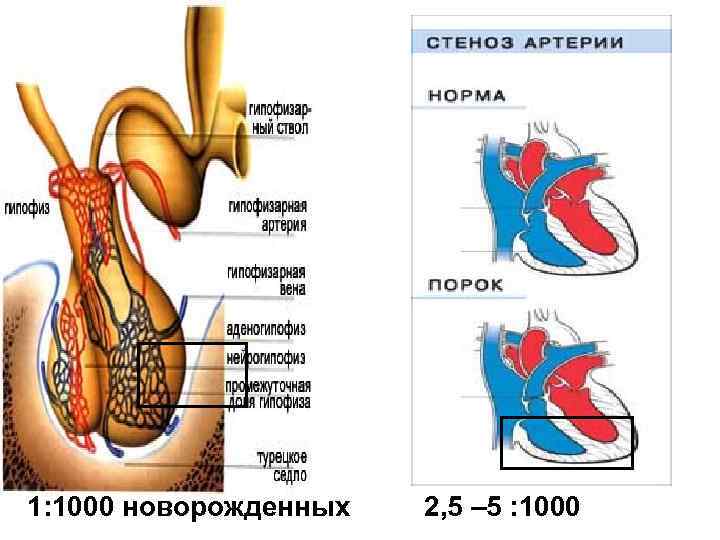1: 1000 новорожденных 2, 5 – 5 : 1000 
