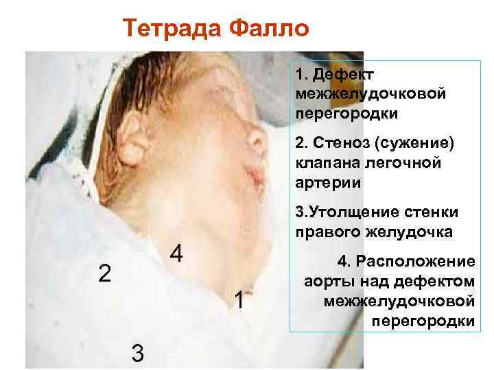 Тетрада Фалло 1. Дефект межжелудочковой перегородки 2. Стеноз (сужение) клапана легочной артерии 3. Утолщение