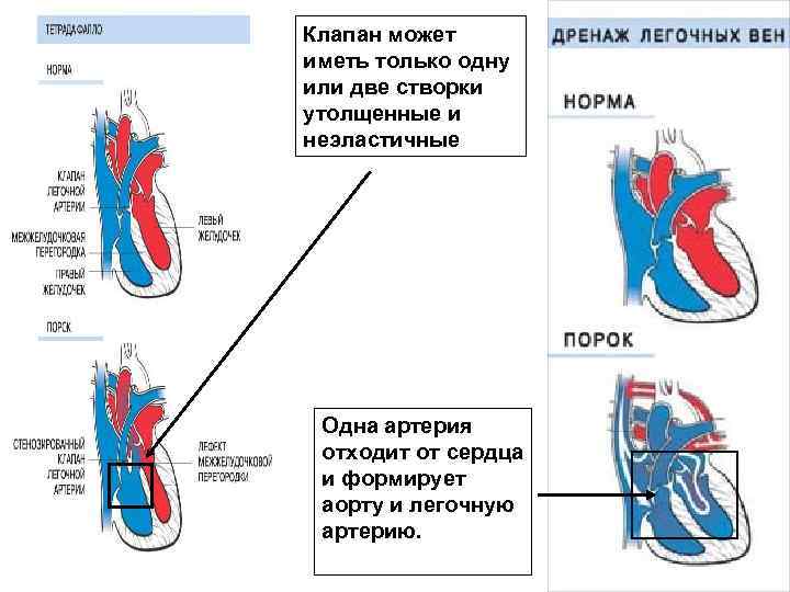 Клапан может иметь только одну или две створки утолщенные и неэластичные Одна артерия отходит