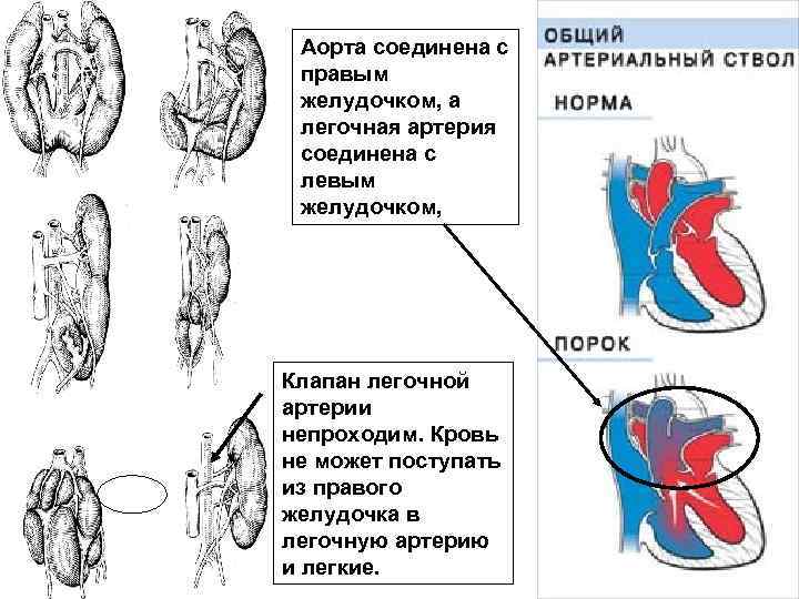 Аорта соединена с правым желудочком, а легочная артерия соединена с левым желудочком, Клапан легочной