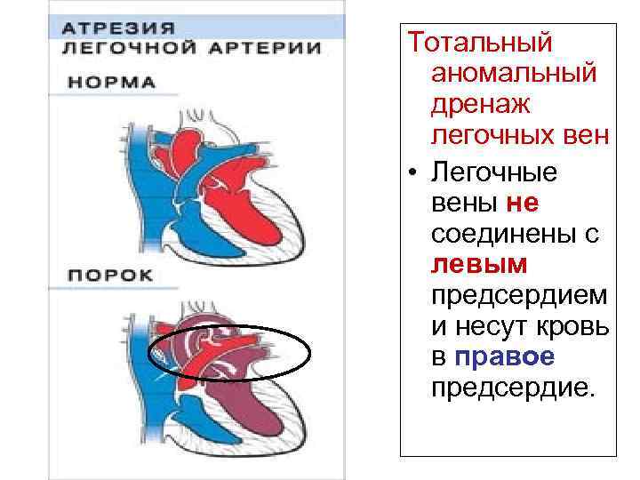 Частичный аномальный дренаж легочных вен