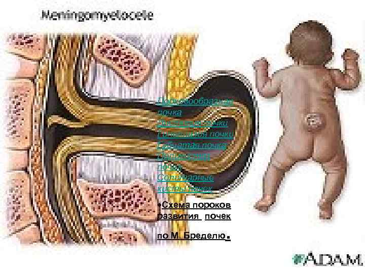 Подковообразная почка Дистопия почки Гипоплазия почки Губчатая почка Поликистоз почек Солитарные кисты почек Схема