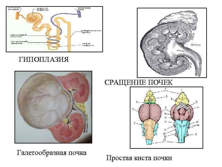 Гипоплазия почки. Галетообразное сращение почек.