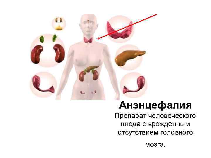 Анэнцефалия Препарат человеческого плода с врожденным отсутствием головного мозга. 