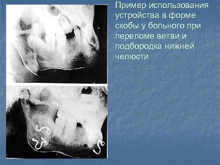 Пример использования устройства в форме скобы у больного при переломе ветви и подбородка нижней