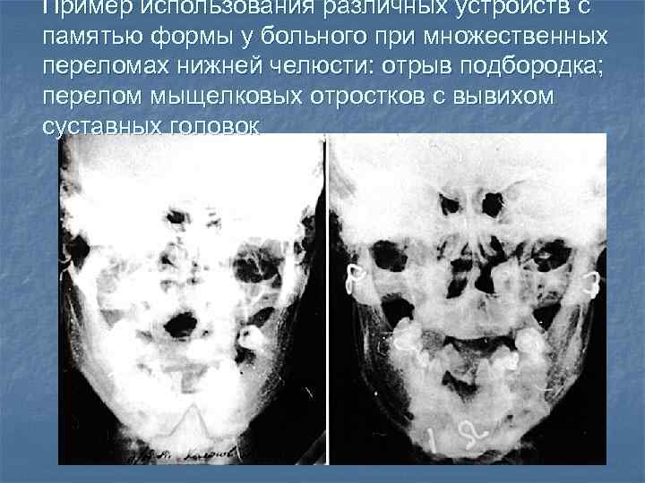 Пример использования различных устройств с памятью формы у больного при множественных переломах нижней челюсти: