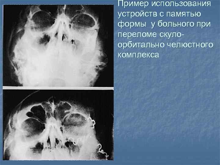 Приобретенные деформации скулоорбитального комплекса и носа презентация