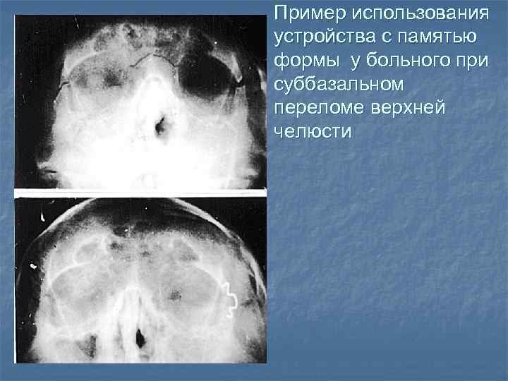 Пример использования устройства с памятью формы у больного при суббазальном переломе верхней челюсти 