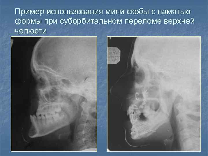 Пример использования мини скобы с памятью формы при суборбитальном переломе верхней челюсти 